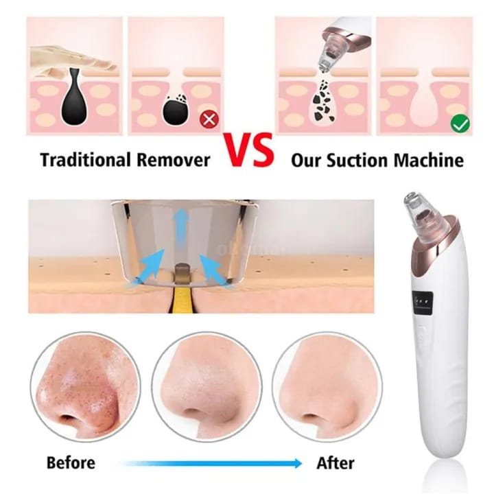 Close-up shot of a whitehead and blackhead remover vacuum tool extracting impurities from the nose pores.