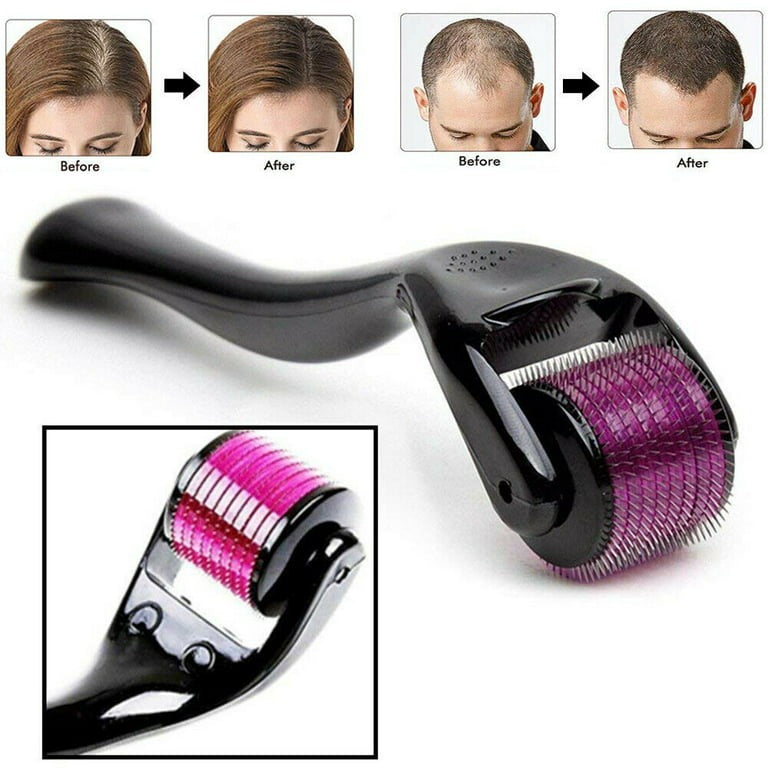Close-up of a 0.5mm titanium microneedling derma roller being sanitized for professional at-home acne scar treatment.